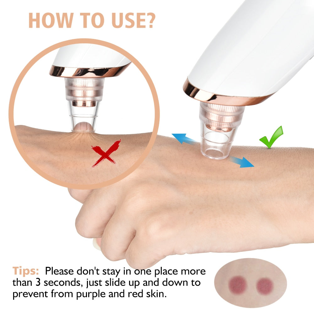 Blackhead Vacuum / Remove Pimples and Clears Pours